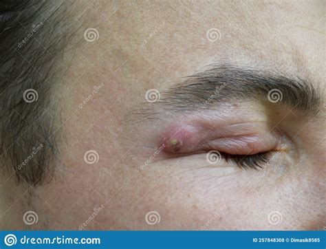 Boil A Strong Purulent Abscess In A Man Near The Eye Stock Photo
