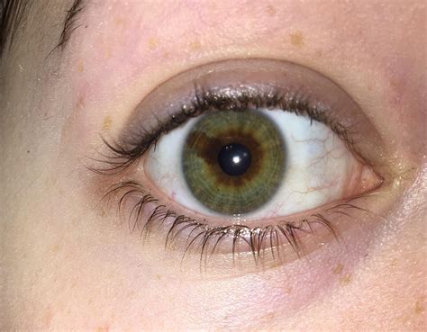 I Have A Brown Line Through The Green Of My Eye Also Known As Sectoral Heterochromia Sectoral