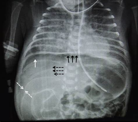 Radiological Signs Of Pneumoperitoneum In An Extremely Low Birthweight