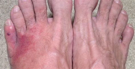 Bacterial Infection Foot Fungus Misdiagnosedis As Cellulitis Hanna