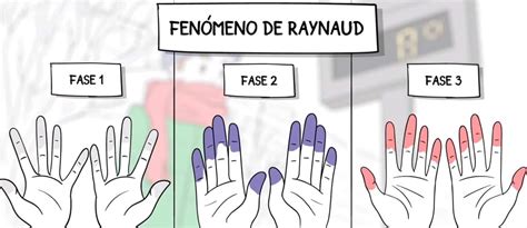 Fenómeno De Raynaud Doctora Feijoo