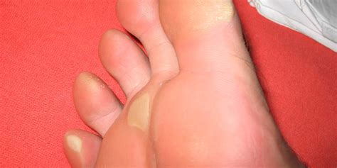 Remove Dead Skin From Your Feet Using These Home Remedies Remove Dead Skin From Your Feet Using