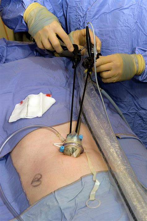 Hernia Surgery Photograph By Dr P Marazziscience Photo Library