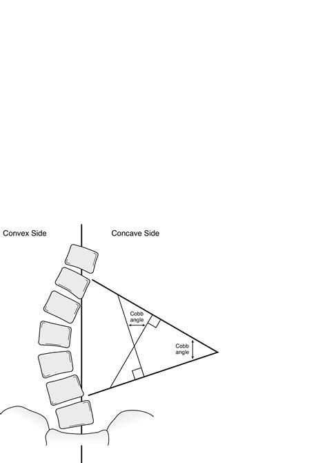 Table: Ángulo de Cobb - Manual MSD versión para profesionales