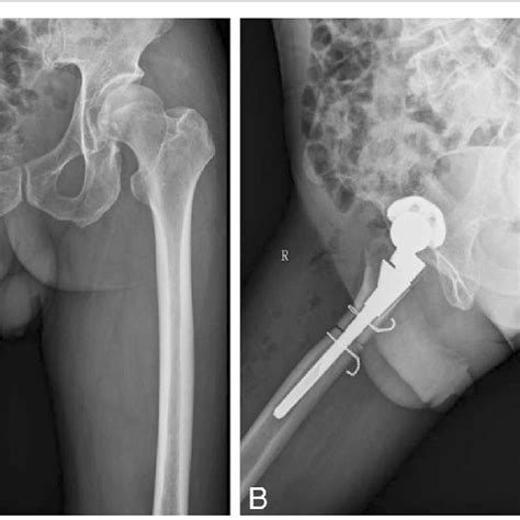 Radiographs Of Both Lower Extremities And The Right Hip After The