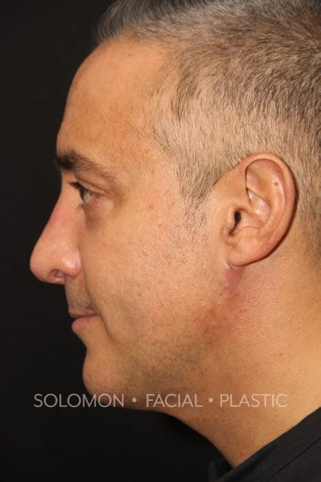 Patient 10 Solomon Facial Plastic