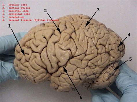 Cerebral hemisphere