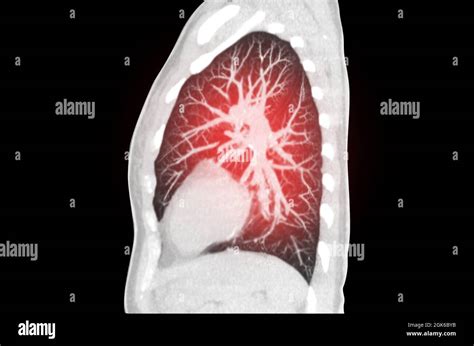 Ct Scan Of Chest Or Lung Sagittal Mip View Of Lung Infection Covid 19