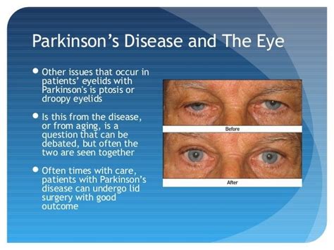 Can Parkinsons Cause Double Vision