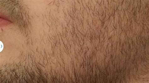 Swarms of lymphocytes surround the basis of the follicles, inducing loss of pigmented terminal hair and subsequently inhibit further hair growth. THREAD CLOSED - Rogaine Experiment - Page 475 - Beard Board