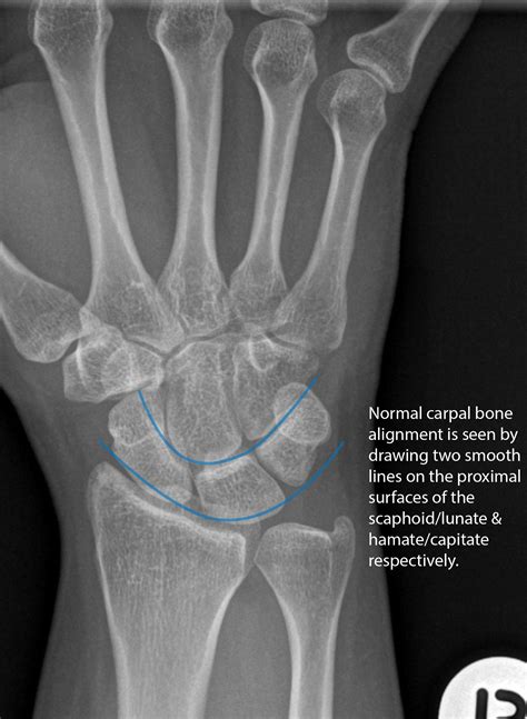 Not Your Typical Wrist Pain — Em Curious