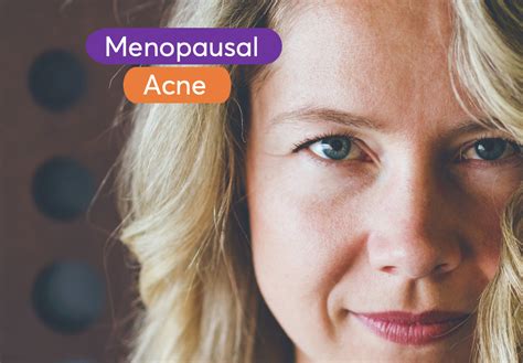 Menopausal Acne Best Treatments According To Dermatologists Mdacne