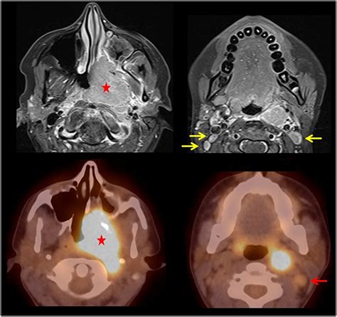 Frontiers Pediatric Nasopharyngeal Carcinoma As Seen On 18f Fdg Petct