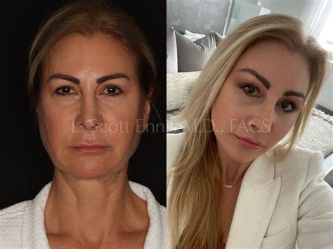 Deep Plane Facelift Before After Photos Ennis Plastic Surgery In Boca Raton