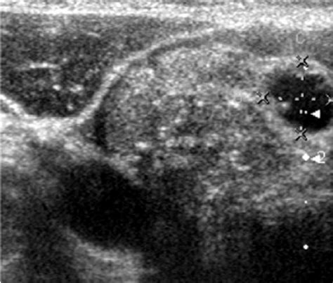 Ultrasonography Of Case With Papillary Thyroid Cancer Showing