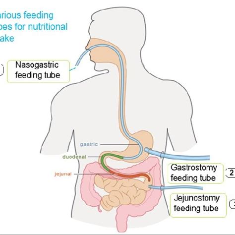 Percutaneous Endoscopic Gastrostomy Feeding Tubes Are