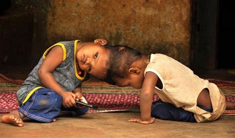 सिर से जुड़े ओडिशा के इन जुड़वां भाइयों को मिलेगी नई जिंदगी Aiims में पहली बार होगी ऐसी सर्जरी