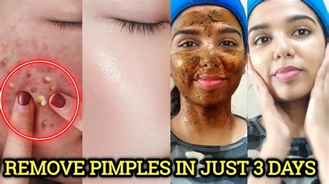 3 Days Pimple Remove Challenge How To Remove Pimples Overnightacne