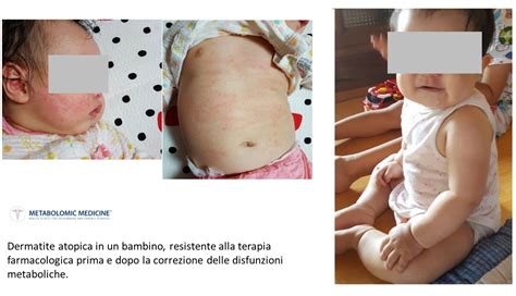 Dermatite Atopica Eczema