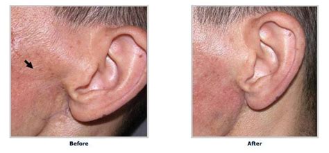 Parotidectomy Plastic Surgery For Facial Deformity Correction