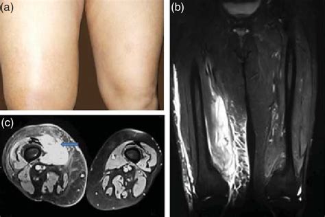 A Swelling Of Right Thigh B T2w Fat Saturated Mri Coronal