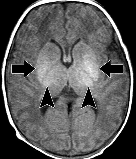 Hypoxic Ischemic Brain Injury Imaging Findings From Birth To Adulthood