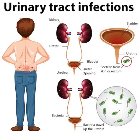 Urinary Tract Infections Utis Symptoms Free Vector Venzero