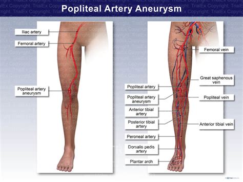 Popliteal Artery Aneurysm Trial Exhibits Inc