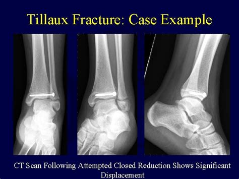 Pediatric Ankle Fractures Anthony I Riccio Md Texas