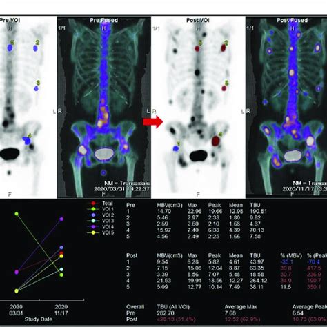 Two Bone Spectct Scans Of A 64 Year Old Female With Bone Metastases