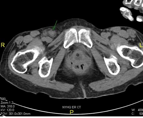 Femoral Hernia Sac Laparoscopy A Case Report Sages Abstract Archives