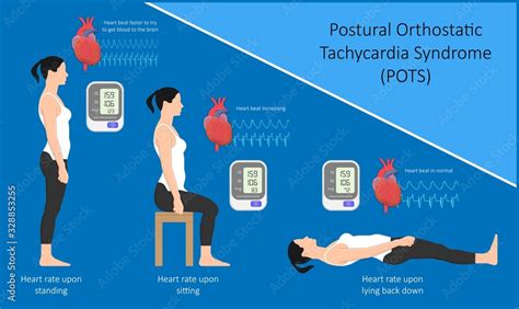 Postural Orthostatic Tachycardia Syndrome Pots Intolerance Tilt Table