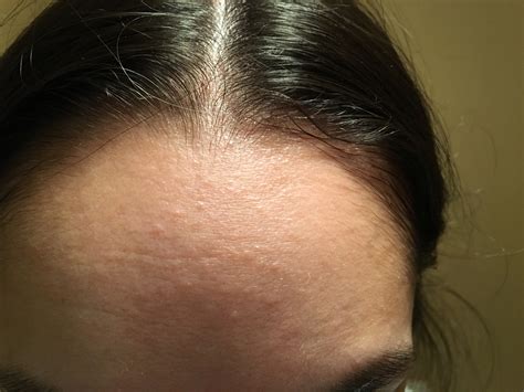 Small Red Bumps On Forehead Pictures Photos Rezfoods Resep Masakan