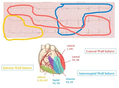 Grouping Leads On A 12 Lead Ekg Where They Represent Medical School