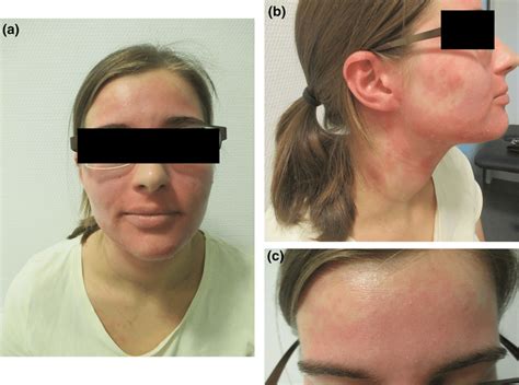 Ac Distinctly Overheated Sharply Defined Erythema On The Face