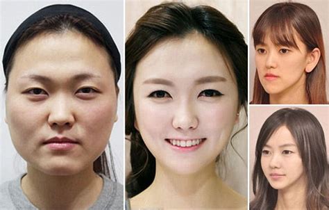 Korean Before And After The Plastic Surgery