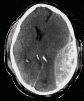 Computed Tomography Of Head Of A Patient With A Left Temporal Epidural