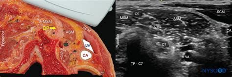 Ultrasound Guided Interscalene Brachial Plexus Nerve Block Nysora