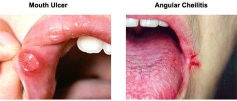 Canker sores are small painful sores on the inside of the mouth. how to cure angular cheilitis : how to treat angular ...