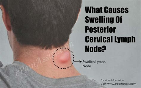 Swollen Posterior Cervical Lymph Nodes In Neck Brwth