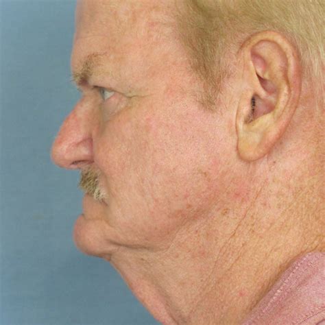 W Plasty Neck Lift Before And After Thomas Funcik Md