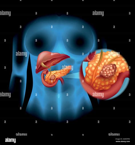Pancreas And Kidney Hi Res Stock Photography And Images Alamy