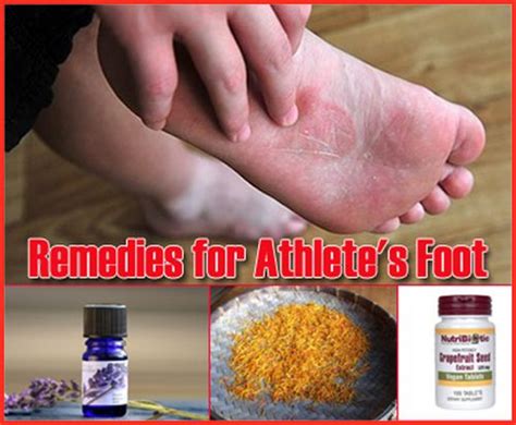 17 Home Remedies For Athletes Foot Athletes Foot Home Remedies Remedies
