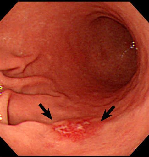 If you are told you have stomach cancer (or gastric cancer), it will almost always be an adenocarcinoma. Dr. Altin Cekodhima
