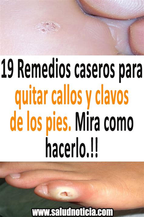 19 Remedios Caseros Para Quitar Callos Y Clavos De Los Pies Mira Como