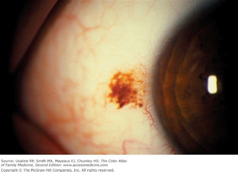 The american rose society and the university of california integrated pest management program note that pesticides containing the active ingredient chlorothalonil are effective. Chapter 14. Scleral and Conjunctival Pigmentation | The ...