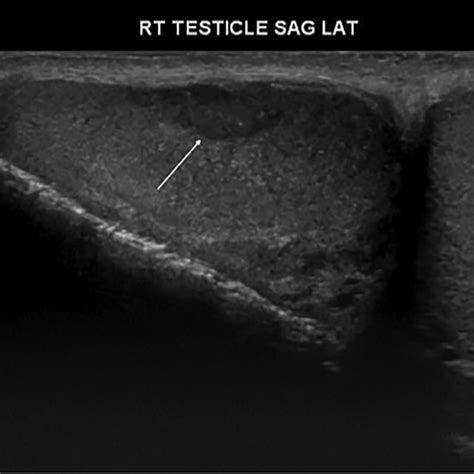 Ultrasound Of The Testicles Demonstrates A Heterogenous Right Testicle Download Scientific