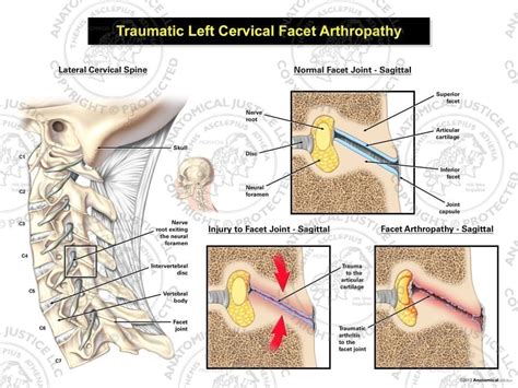 Traumatic Left Cervical Facet Arthropathy