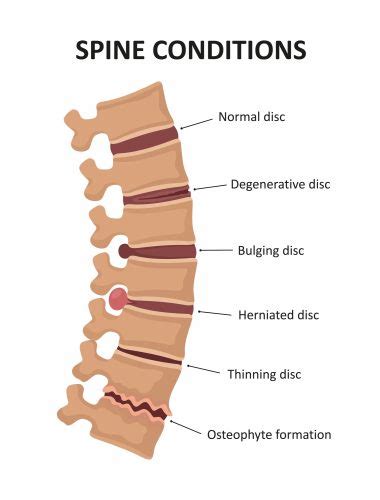 Degenerative Disc Disease Cahaba Pain And Spine Care