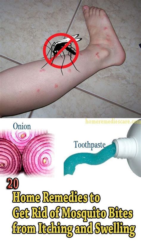20 Home Remedies To Get Rid Of Mosquito Bites From Itching And Swelling Remedies For Mosquito